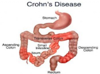 Tình dục và bệnh Crohn có mối liên hệ như thế nào?