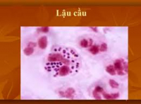 DẤU HIỆU CỦA BỆNH LẬU Ở CẢ NAM VÀ NỮ DẤU HIỆU CỦA BỆNH LẬU Ở CẢ NAM VÀ NỮ