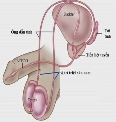 Một số câu hỏi thường gặp ở triệt sản nam Một số câu hỏi thường gặp ở triệt sản nam