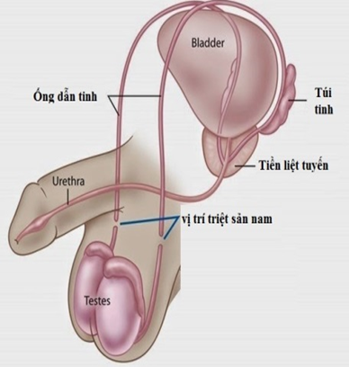 Một số câu hỏi thường gặp ở triệt sản nam