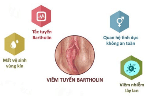 TÌM HIỂU VỀ VIÊM TUYẾN BARTHOLIN TÌM HIỂU VỀ VIÊM TUYẾN BARTHOLIN