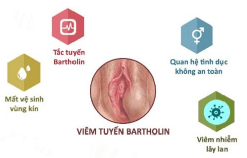 TÌM HIỂU VỀ VIÊM TUYẾN BARTHOLIN 