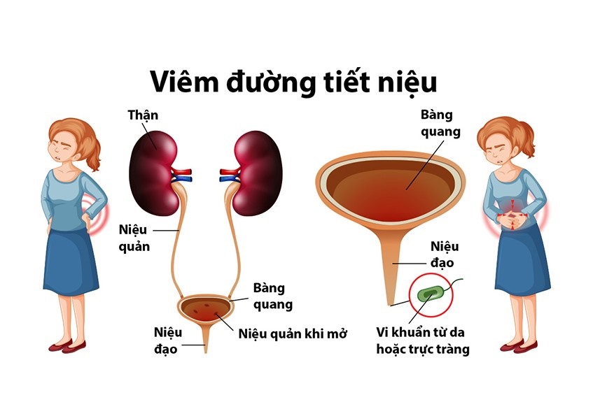 Nhiễm trùng đường tiết niệu ở phụ nữ Nhiễm trùng đường tiết niệu ở phụ nữ